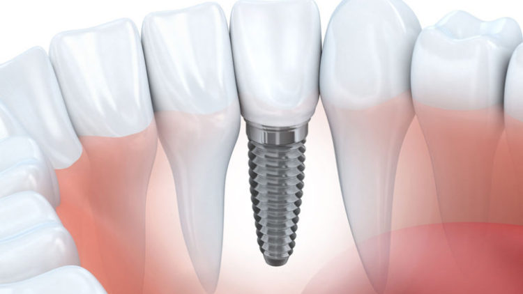 Tehnici moderne pentru implanturile dentare