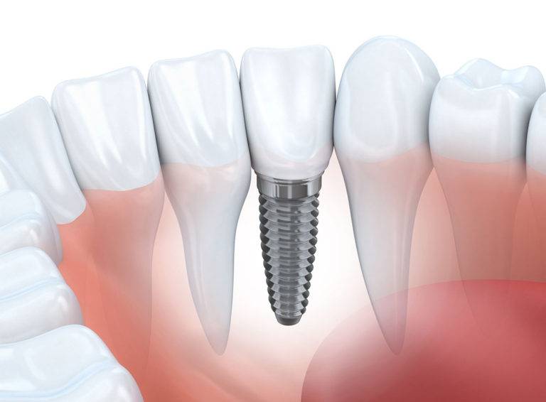 Tehnici moderne pentru implanturile dentare